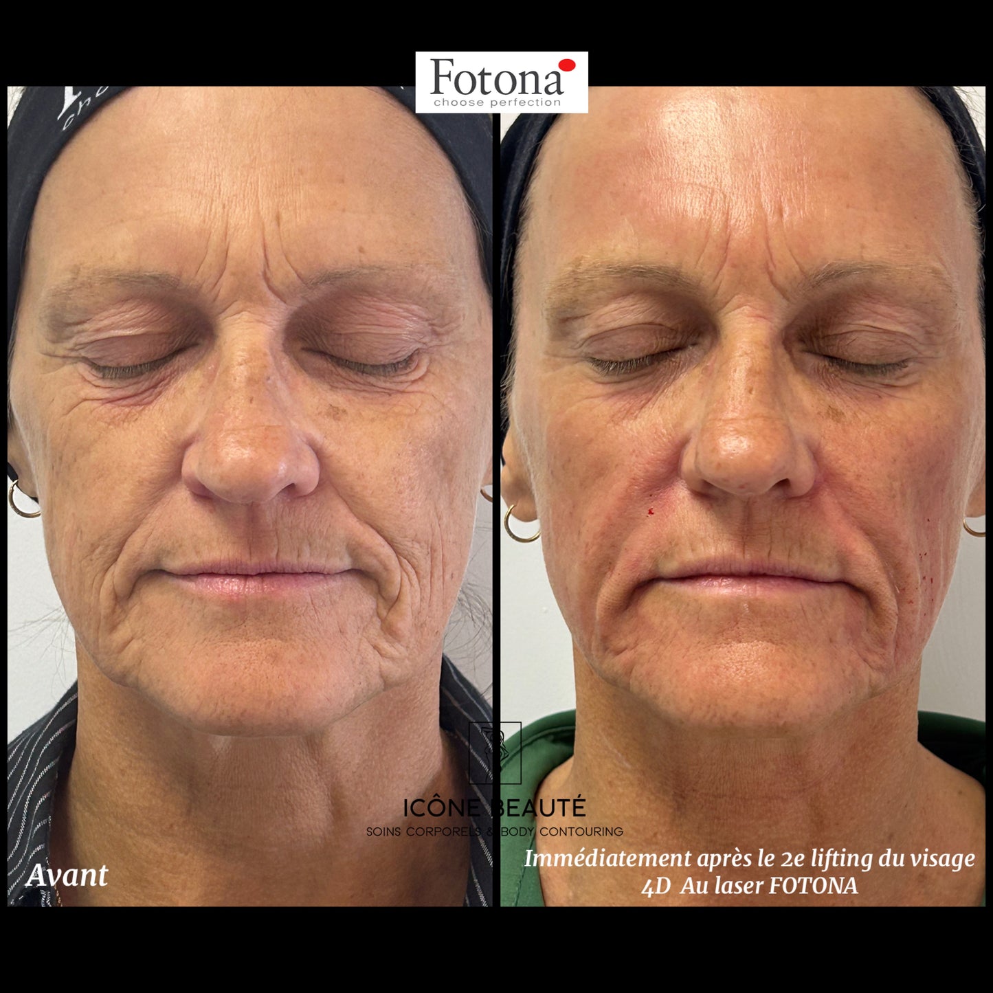 Soin signature Fotona 4D à Québec | SmoothEye + lifting visage complet | Icône Beauté