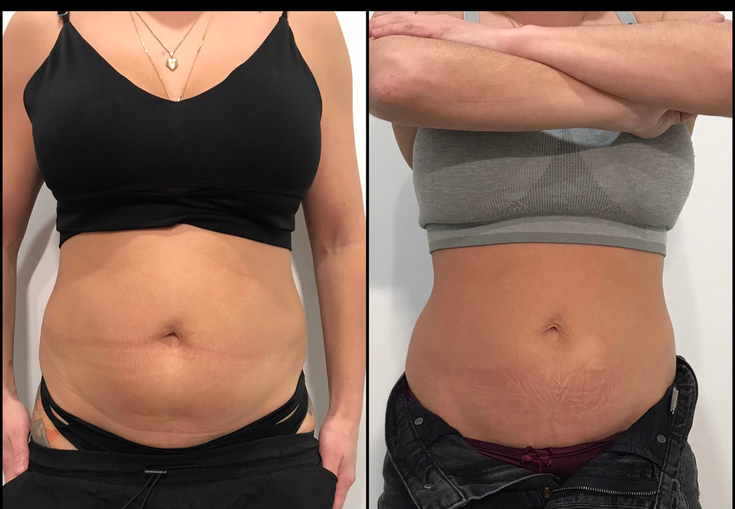 🔥 Cure 4 seances : Hot & Tight EXPRESS – Fonte Adipeuse & Skin Tightening Corps