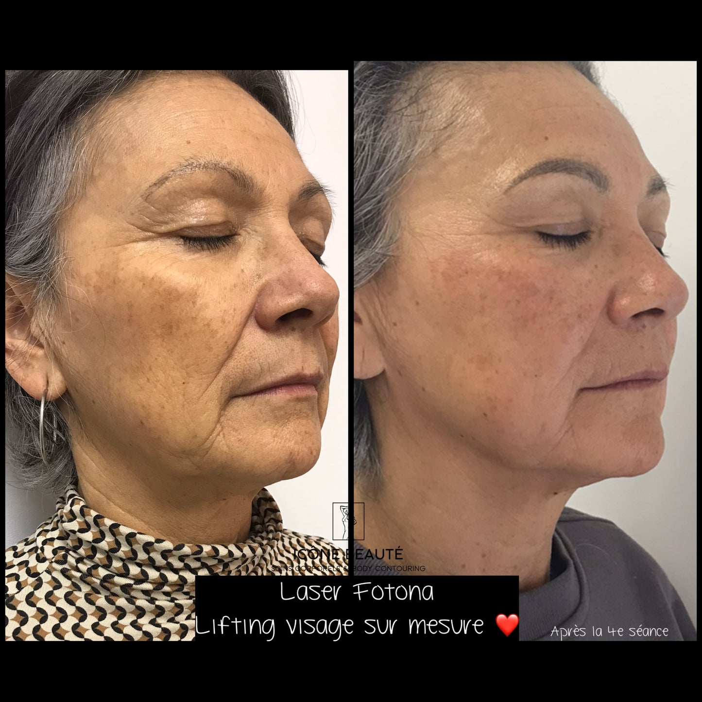 Traitement visage complet Fotona à Québec - 3D | Raffermissement laser | Icône Beauté