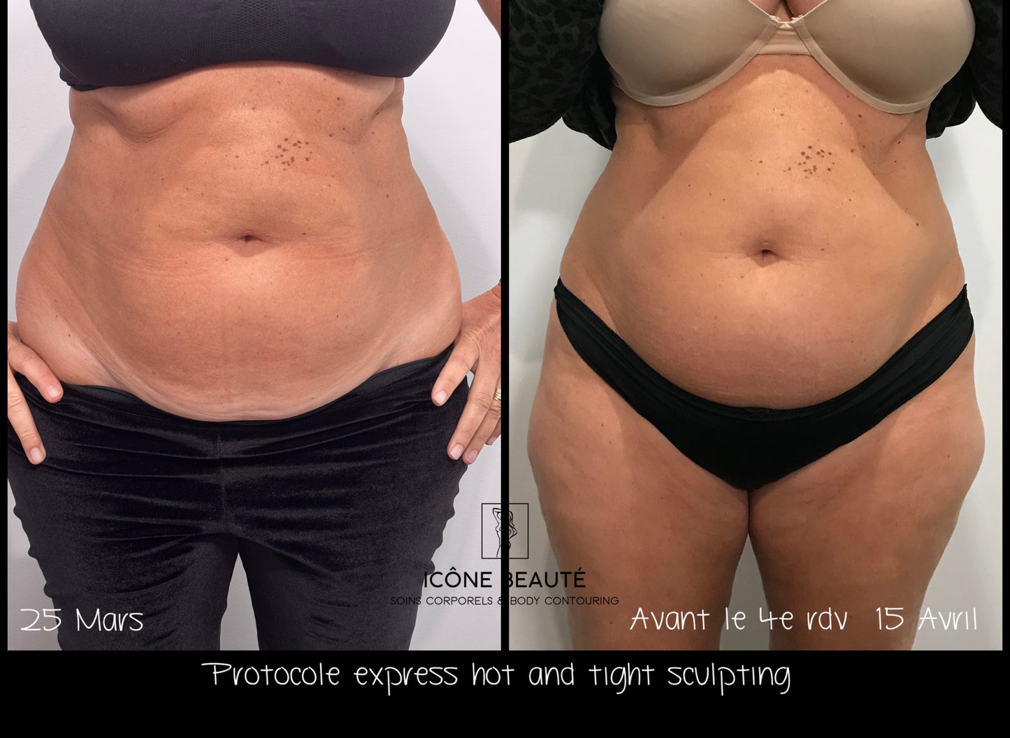 🔥 Cure 4 seances : Hot & Tight EXPRESS – Fonte Adipeuse & Skin Tightening Corps