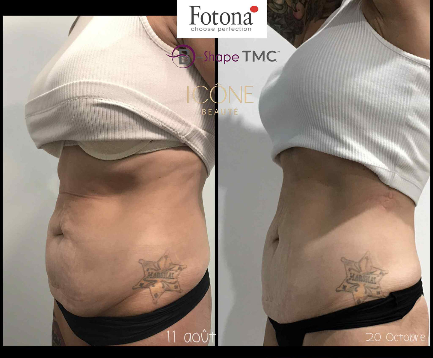 🔥 Hot & Tight Sculpting – Remodelage par Laser Fotona - CORPS