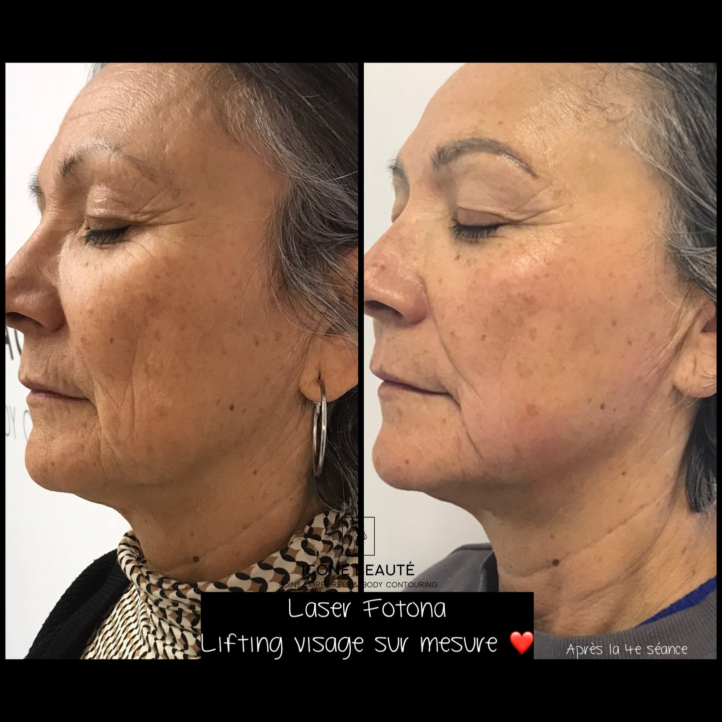 Traitement visage complet Fotona à Québec - 3D | Raffermissement laser | Icône Beauté