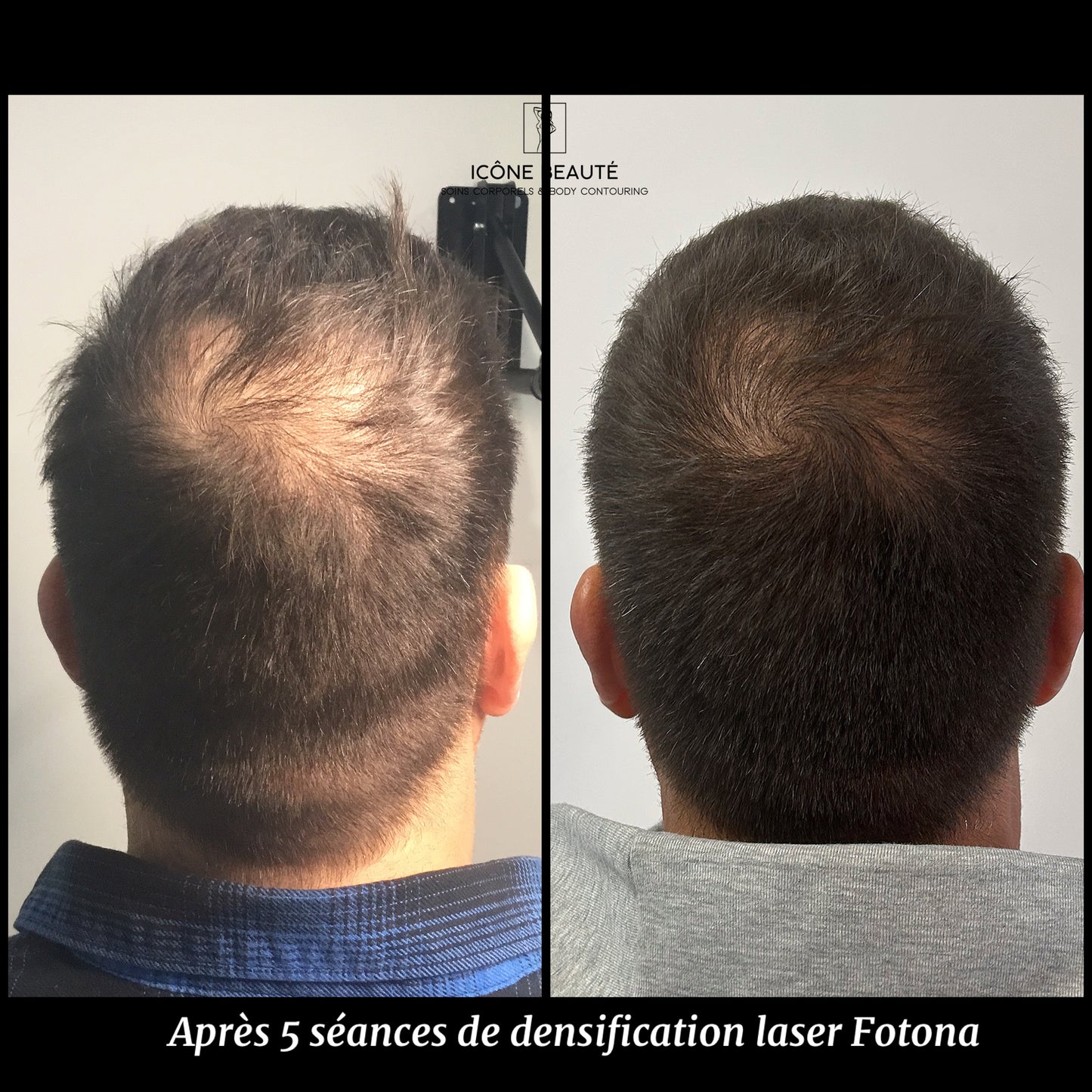 🔹 DENSIFICATION CAPILLAIRE - Laser Fotona - HairRestart®