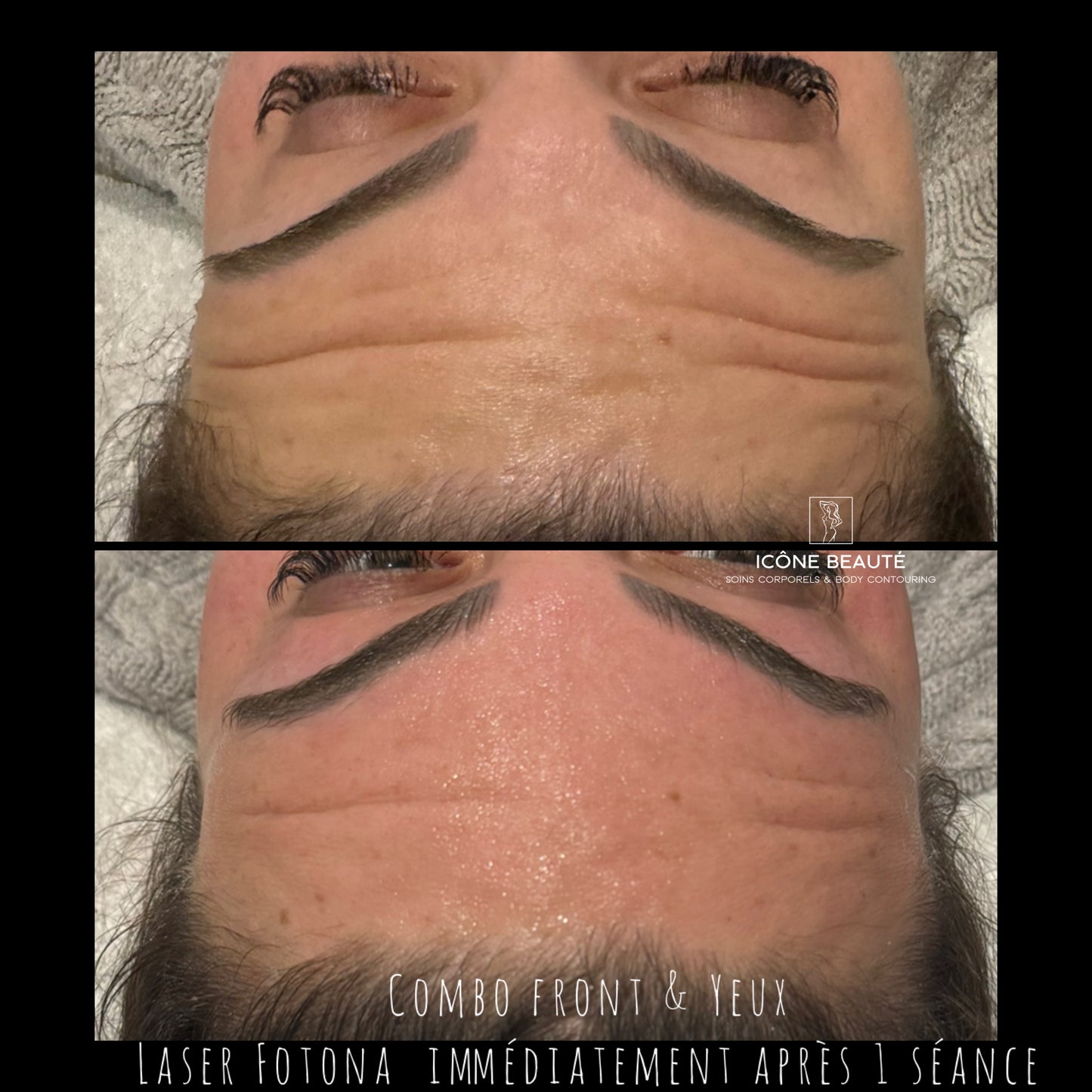 Combo : SmoothEyes® Fotona à Québec | Contour des yeux et front sans injection | Icône Beauté