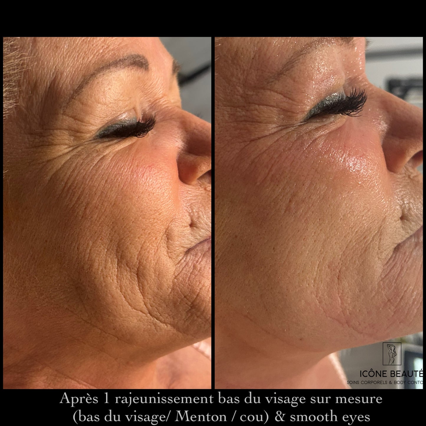 TightSculpting Fotona BASE à Québec | Raffermissement du bas du visage | Icône Beauté