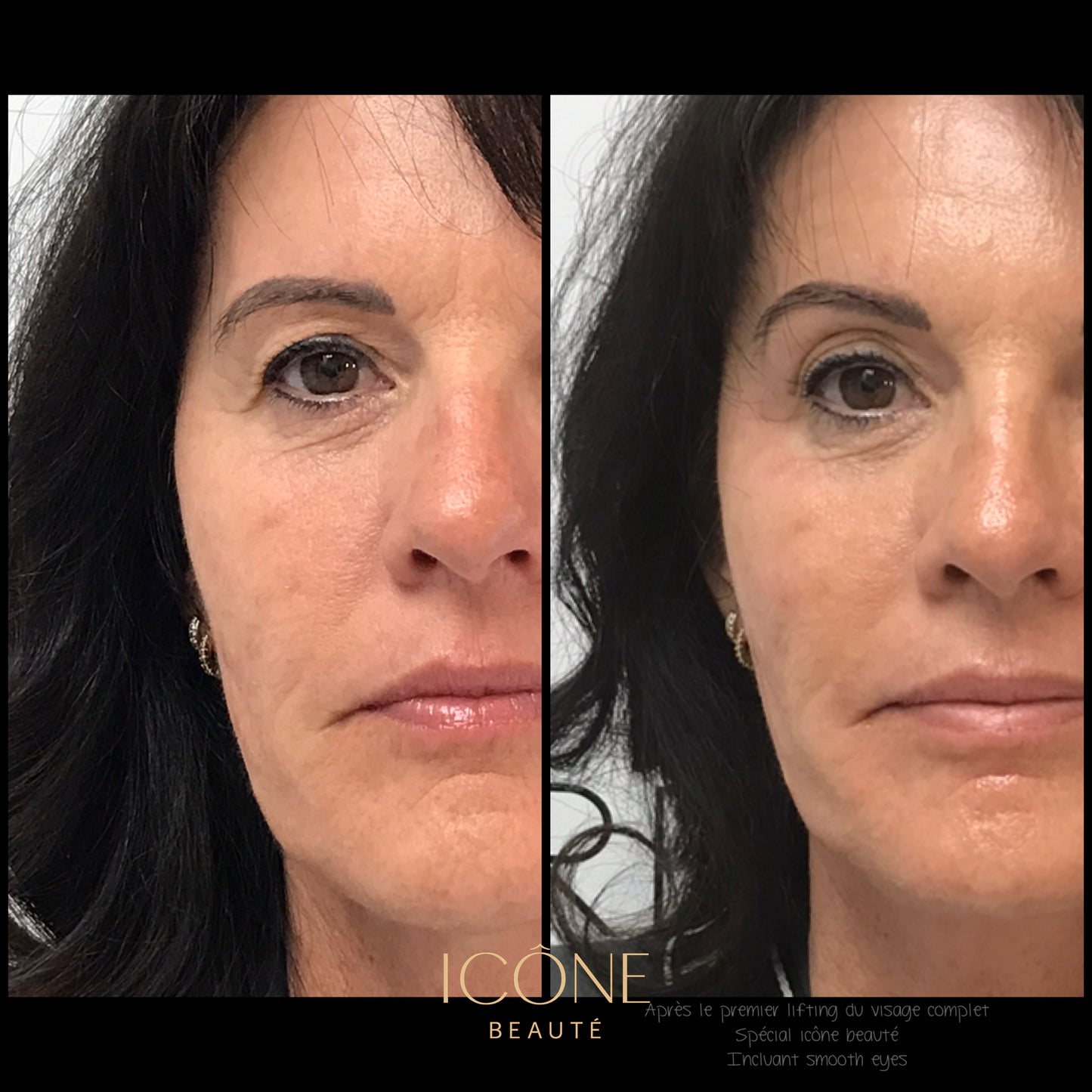 Soin signature Fotona 4D à Québec | SmoothEye + lifting visage complet | Icône Beauté