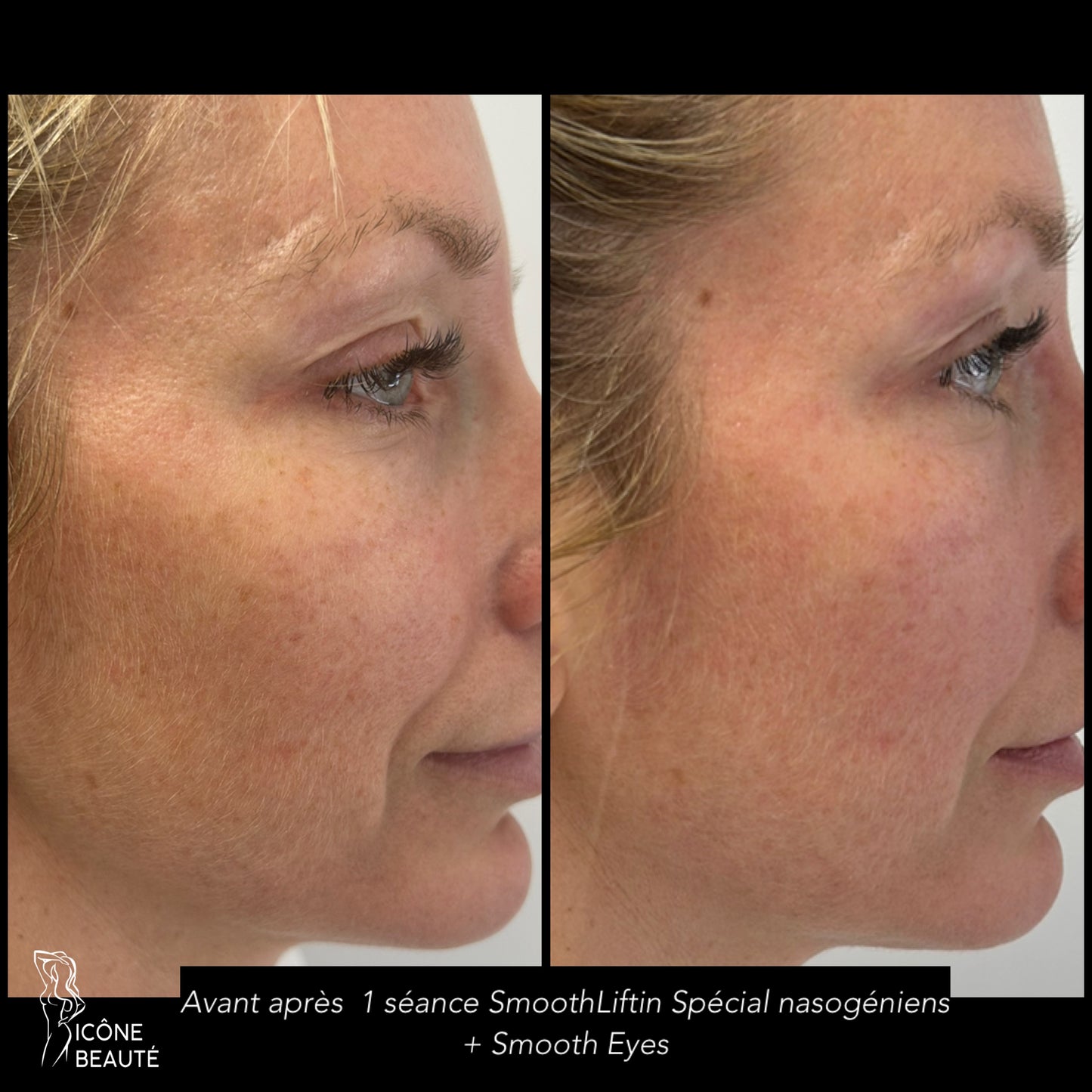 TightSculpting Fotona BASE à Québec | Raffermissement du bas du visage | Icône Beauté