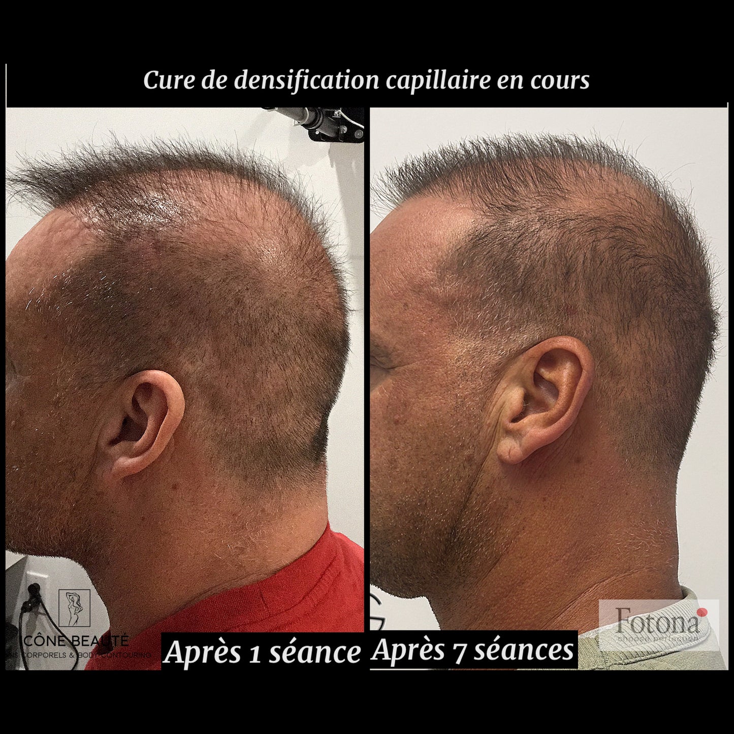 🔹 DENSIFICATION CAPILLAIRE - Laser Fotona - HairRestart®