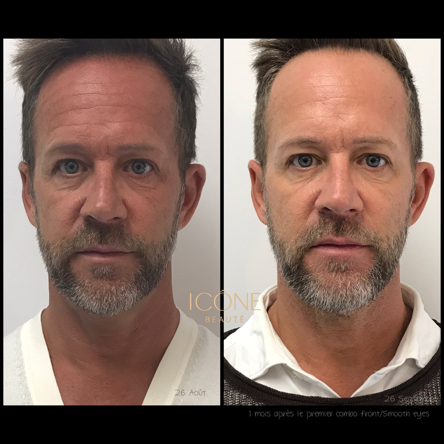 Combo : SmoothEyes® Fotona à Québec | Contour des yeux et front sans injection | Icône Beauté