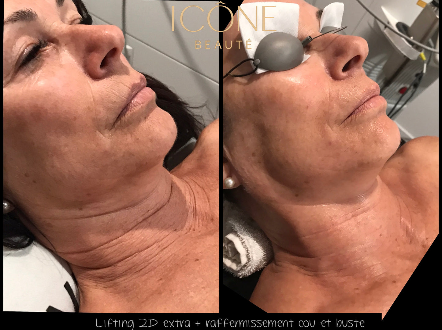 TightSculpting Fotona BASE à Québec | Raffermissement du bas du visage | Icône Beauté