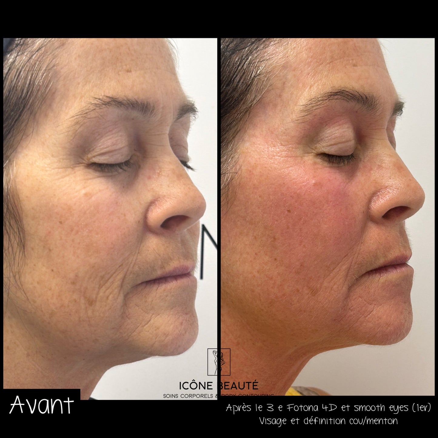 Soin signature Fotona 4D à Québec | SmoothEye + lifting visage complet | Icône Beauté
