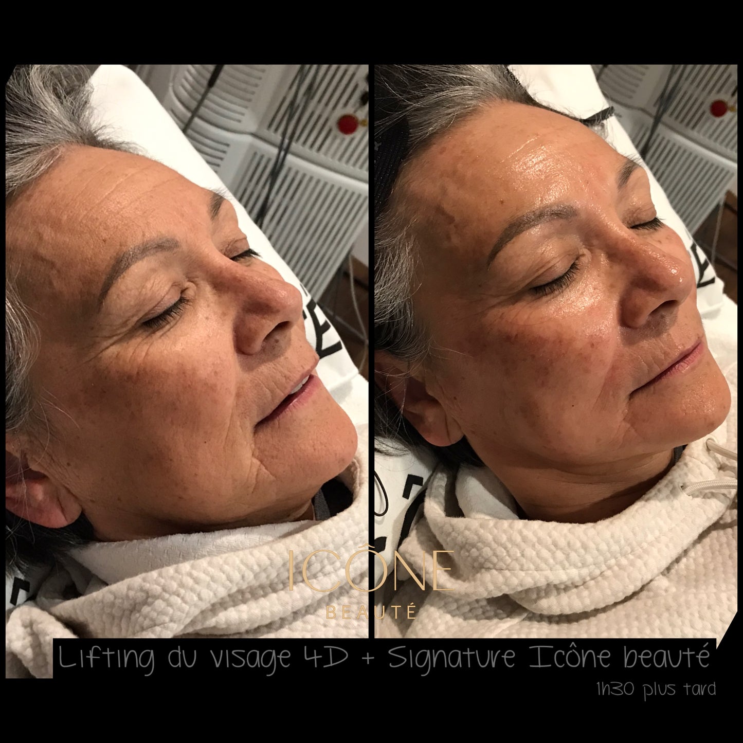 Soin signature Fotona 4D à Québec | SmoothEye + lifting visage complet | Icône Beauté