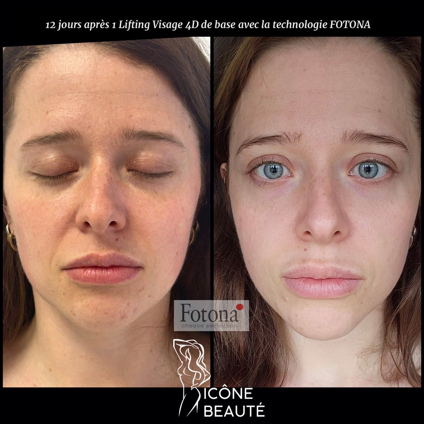 Soin signature Fotona 4D à Québec | SmoothEye + lifting visage complet | Icône Beauté