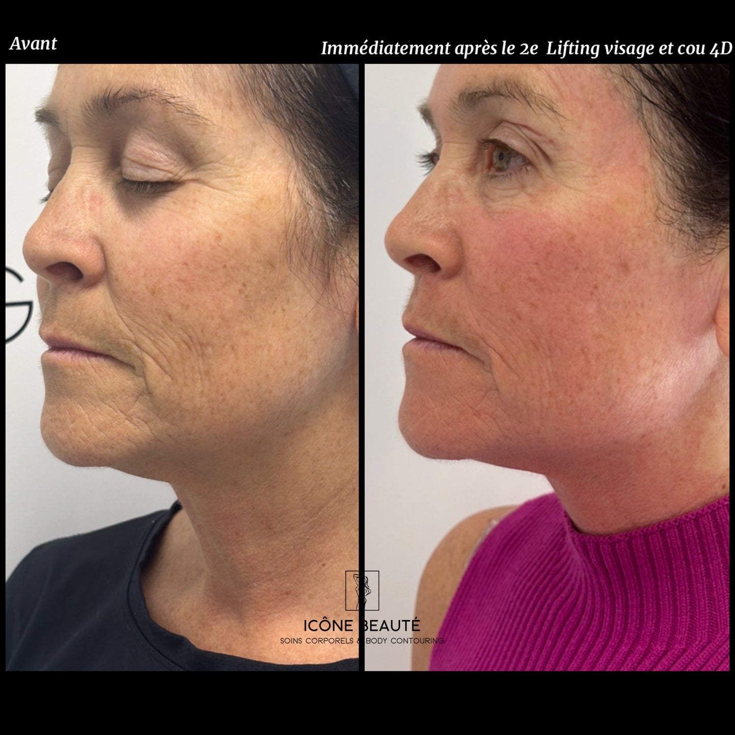 Soin signature Fotona 4D à Québec | SmoothEye + lifting visage complet | Icône Beauté