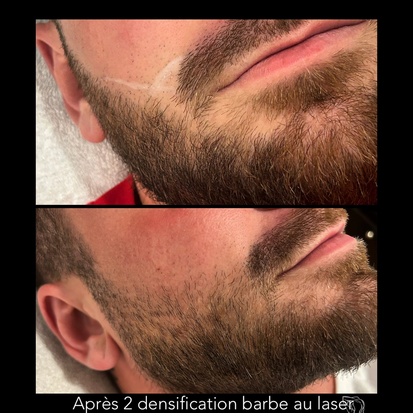 🔹 DENSIFICATION CAPILLAIRE - Laser Fotona - HairRestart®