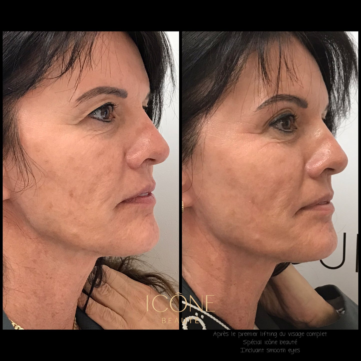 Combo : SmoothEyes® Fotona à Québec | Contour des yeux et front sans injection | Icône Beauté
