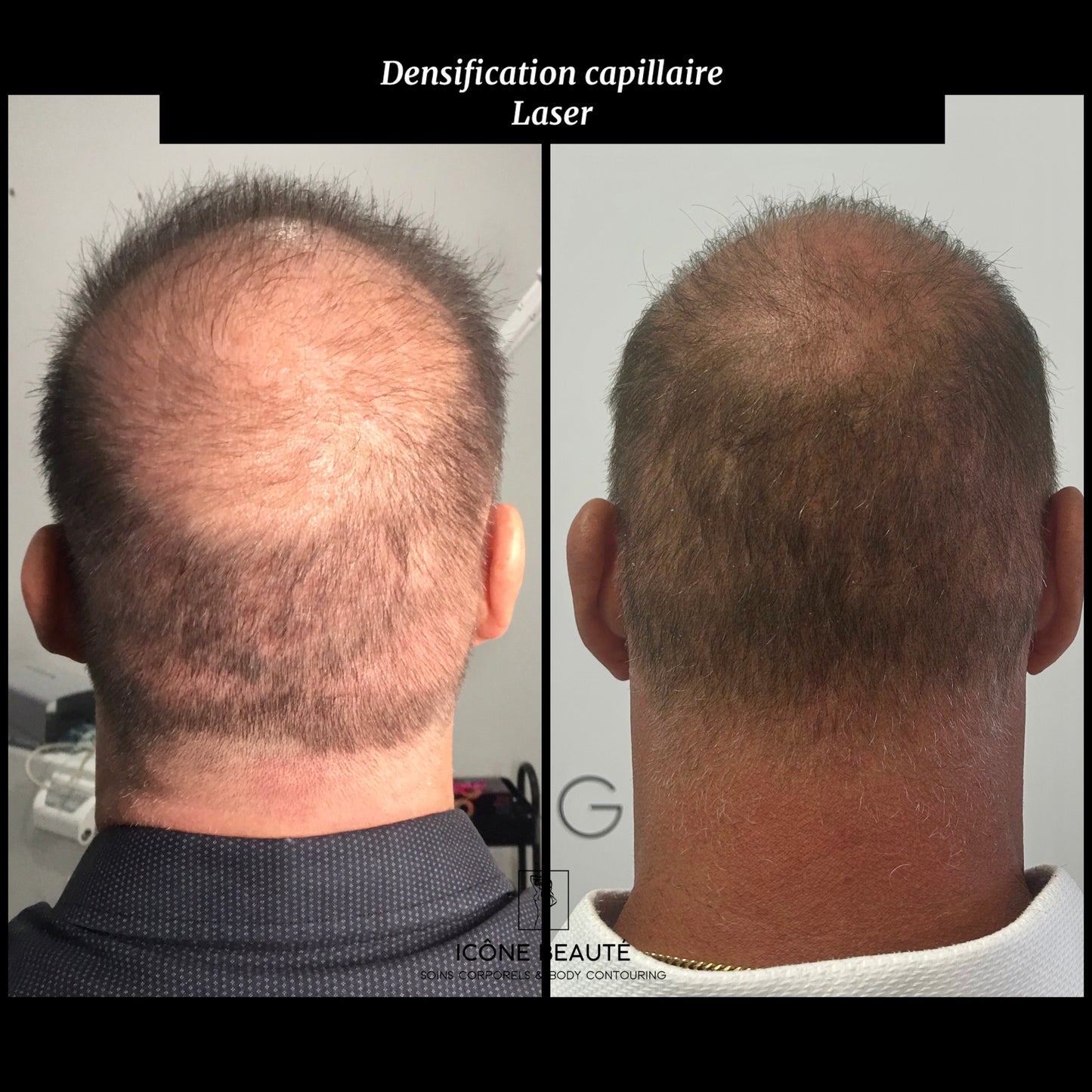 🔹 DENSIFICATION CAPILLAIRE - Laser Fotona - HairRestart®