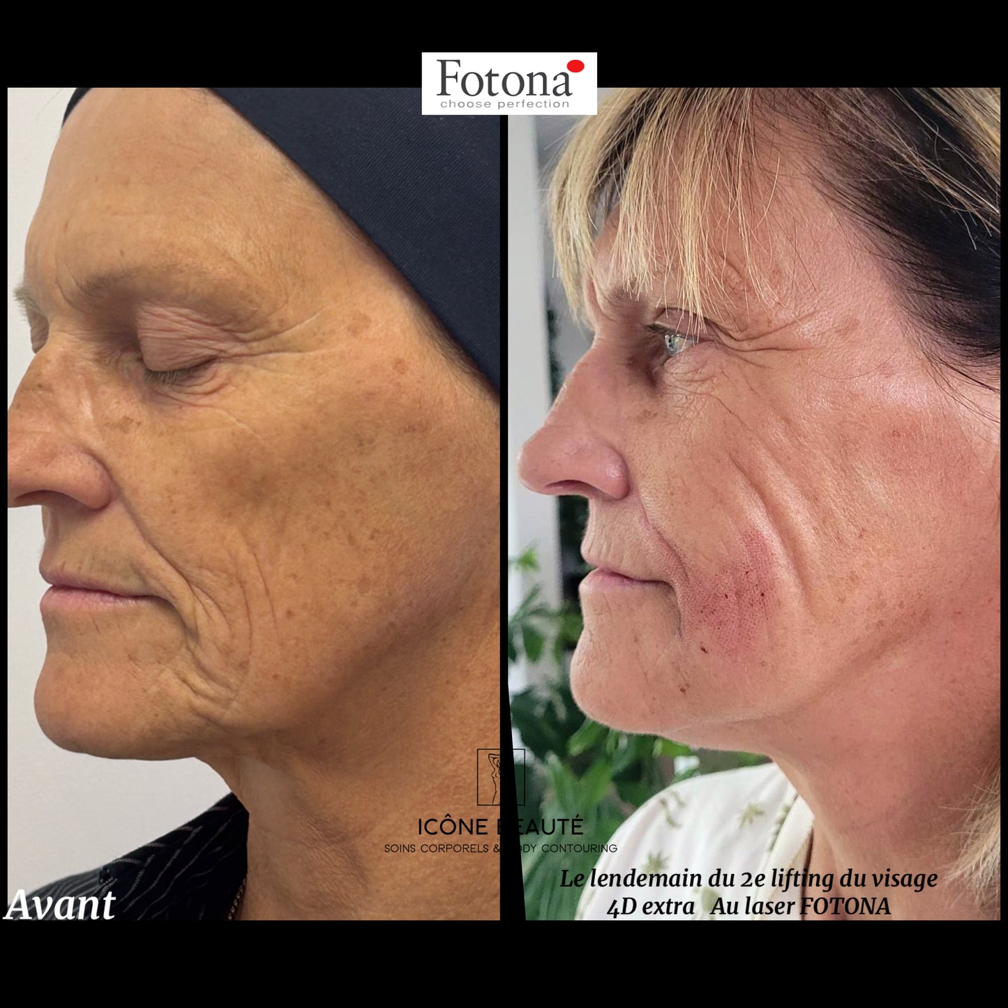 Soin signature Fotona 4D à Québec | SmoothEye + lifting visage complet | Icône Beauté