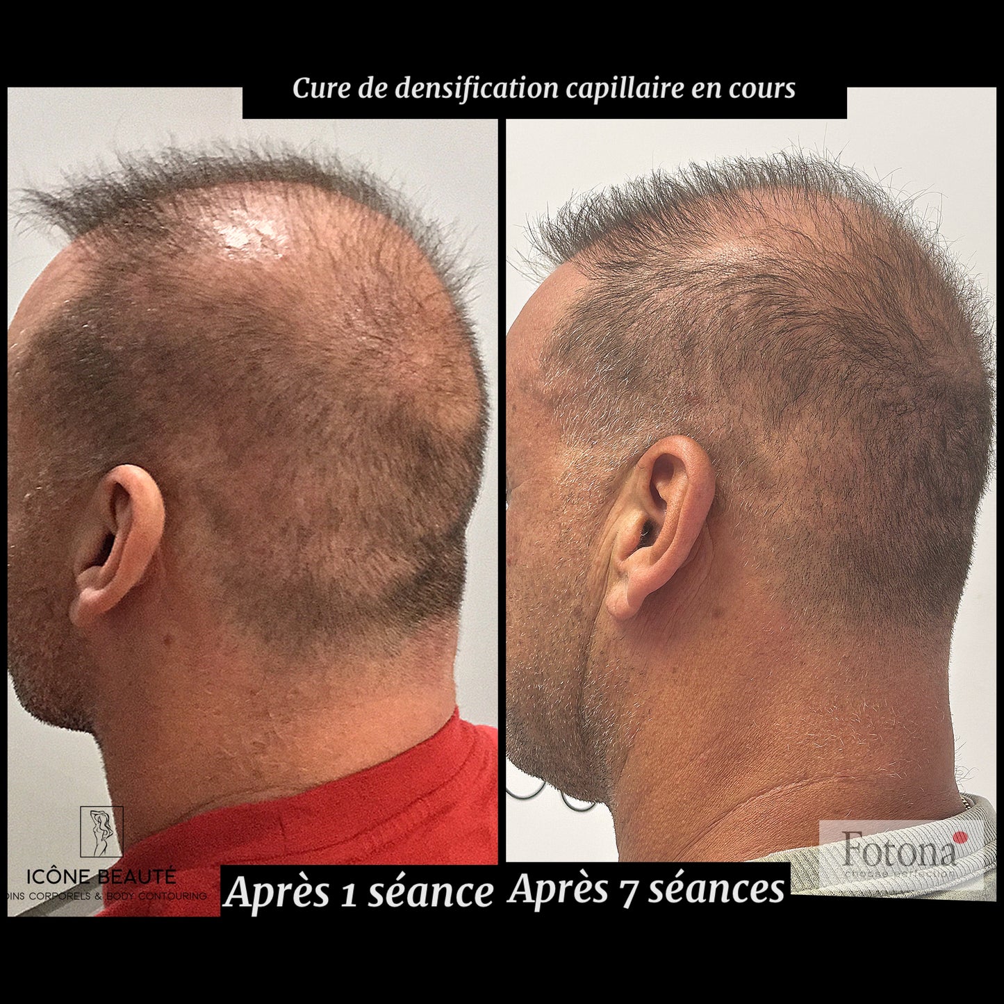 🔹 DENSIFICATION CAPILLAIRE - Laser Fotona - HairRestart®