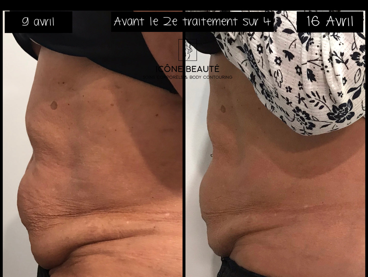 🔥 Cure 4 seances : Hot & Tight EXPRESS – Fonte Adipeuse & Skin Tightening Corps