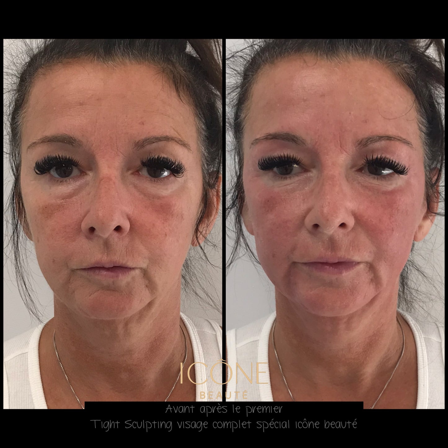 Soin signature Fotona 4D à Québec | SmoothEye + lifting visage complet | Icône Beauté