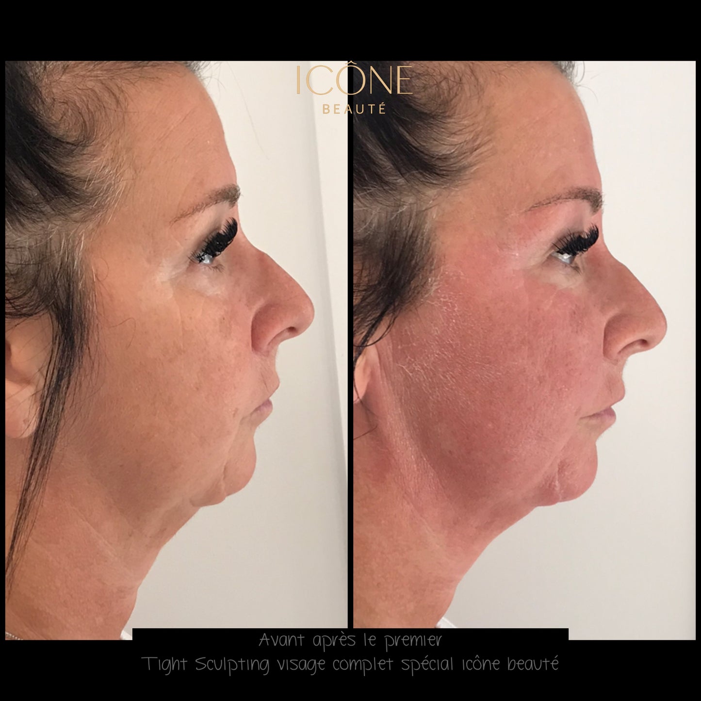 Soin signature Fotona 4D à Québec | SmoothEye + lifting visage complet | Icône Beauté