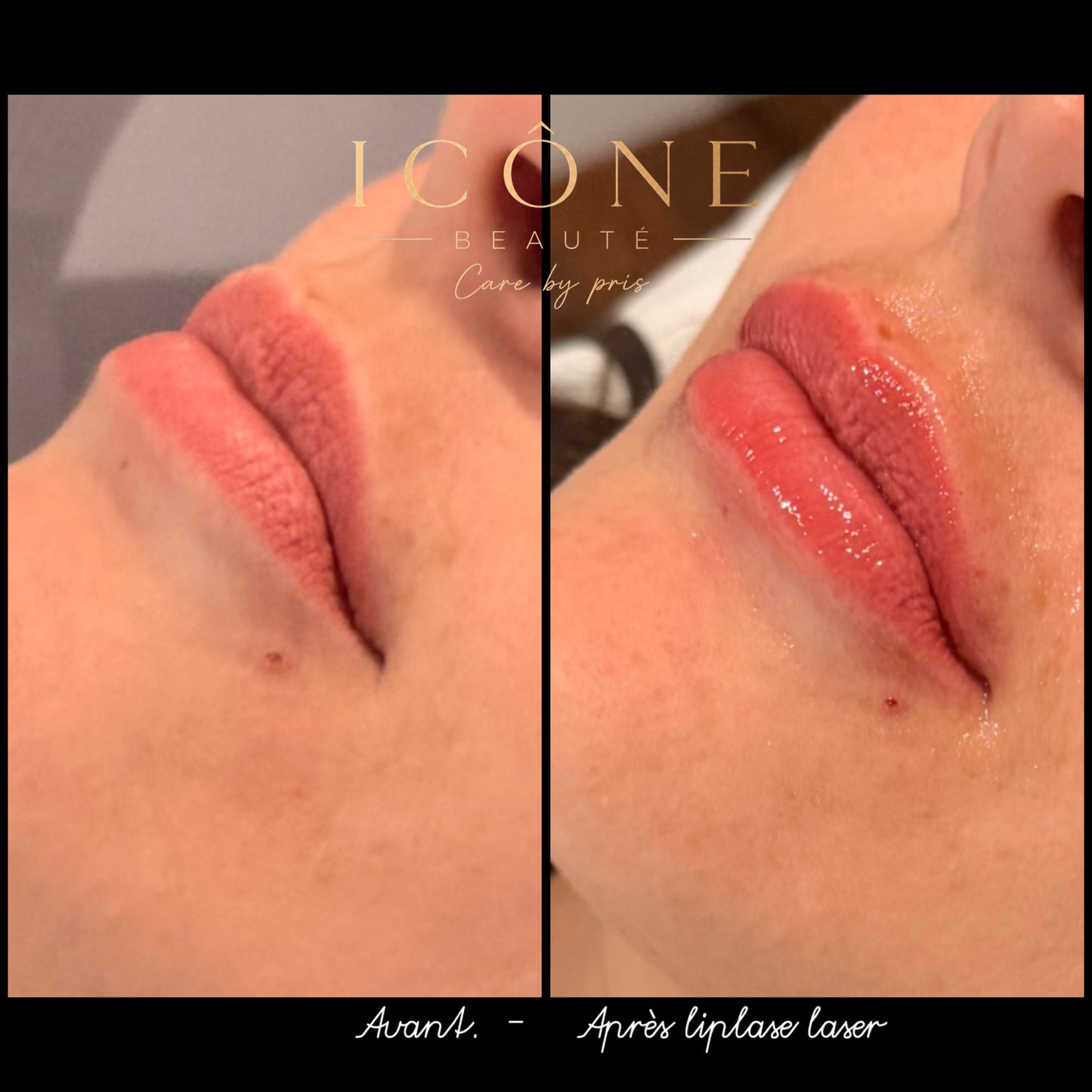 💋 LipLase® – Lèvres pulpeuses au naturel