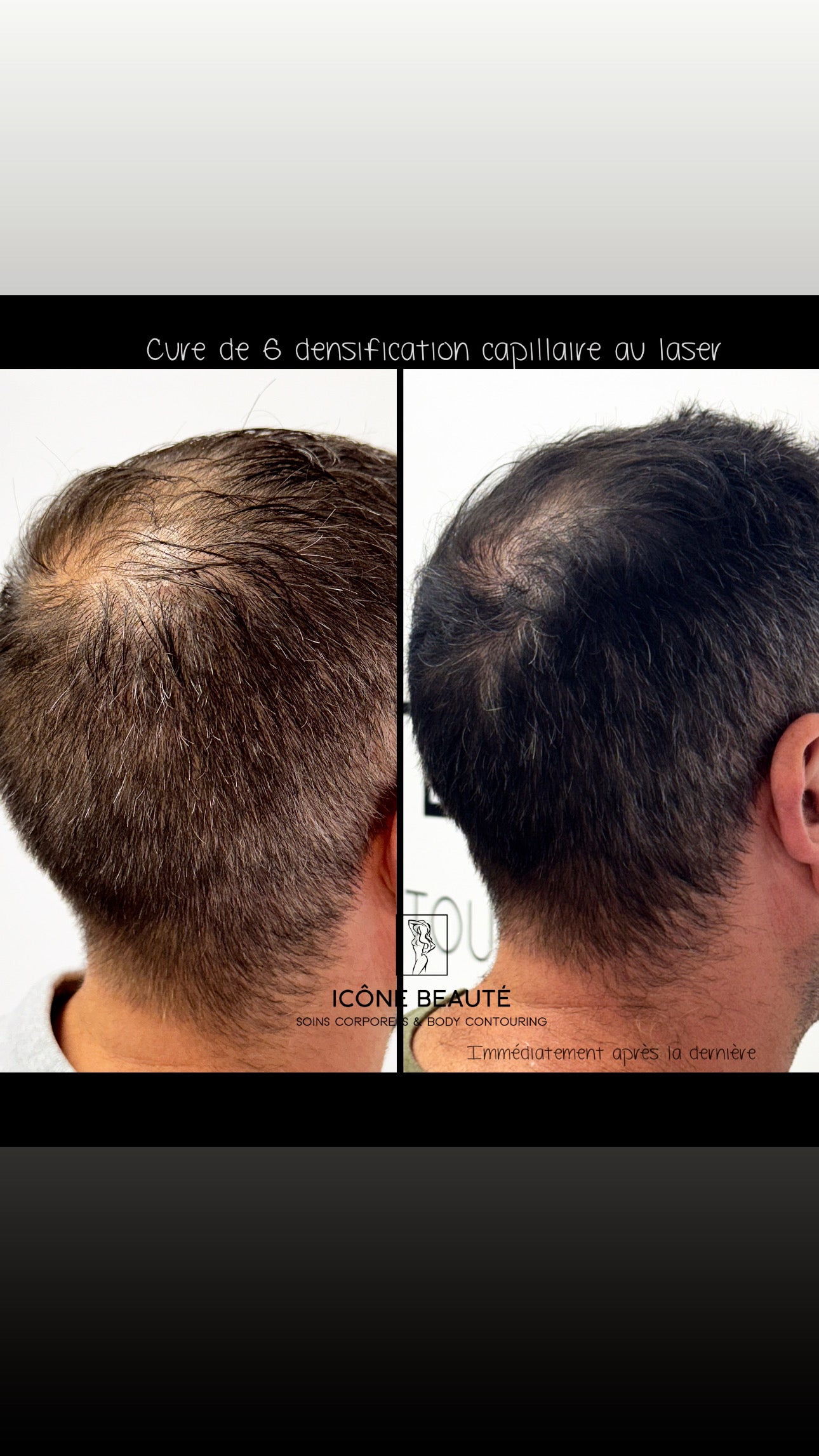 🔹 DENSIFICATION CAPILLAIRE - Laser Fotona - HairRestart®