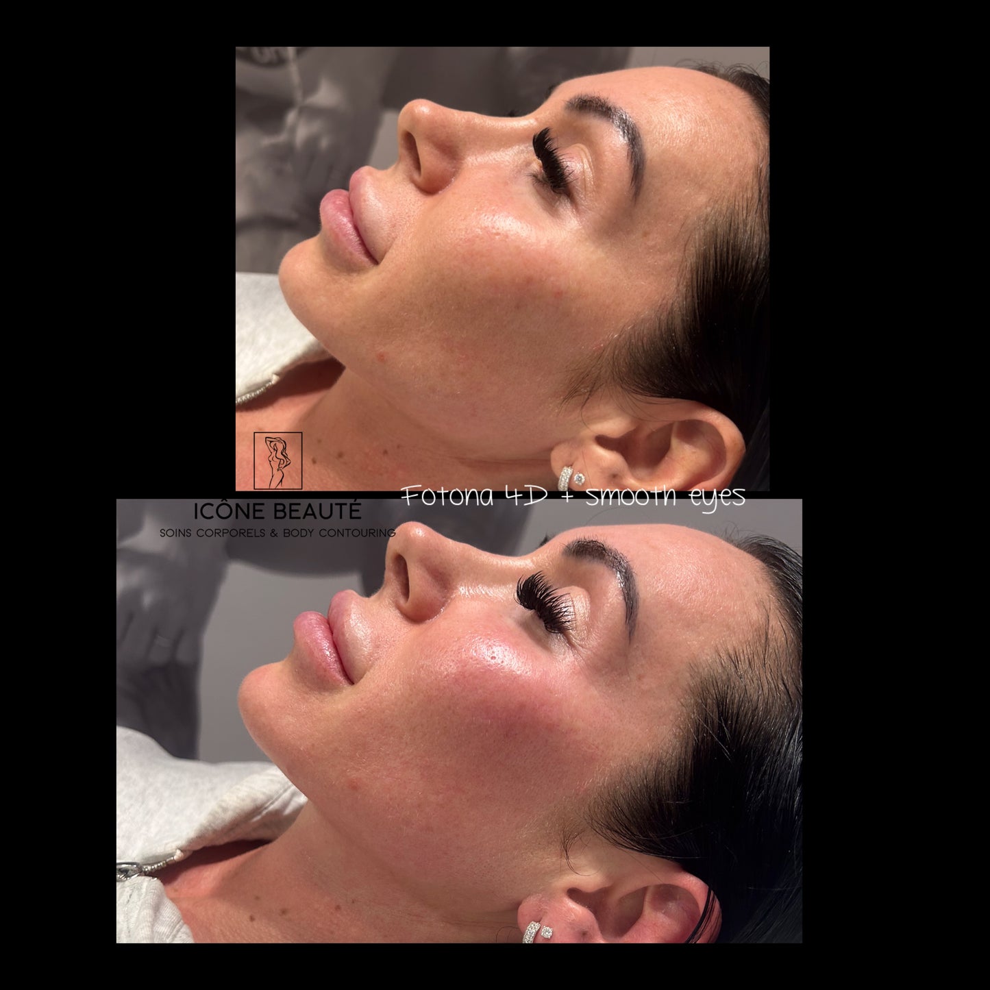 Soin signature Fotona 4D à Québec | SmoothEye + lifting visage complet | Icône Beauté