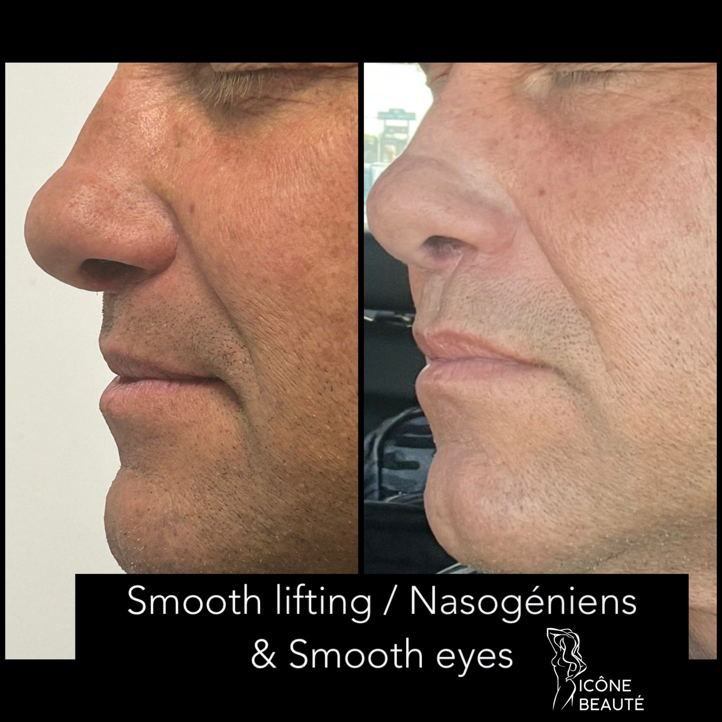 TightSculpting Fotona BASE à Québec | Raffermissement du bas du visage | Icône Beauté