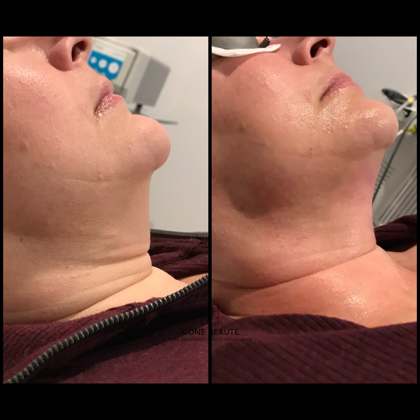 🔥 FOTONA LASER – Hot & Tight Sculpting (Menton / Cou)