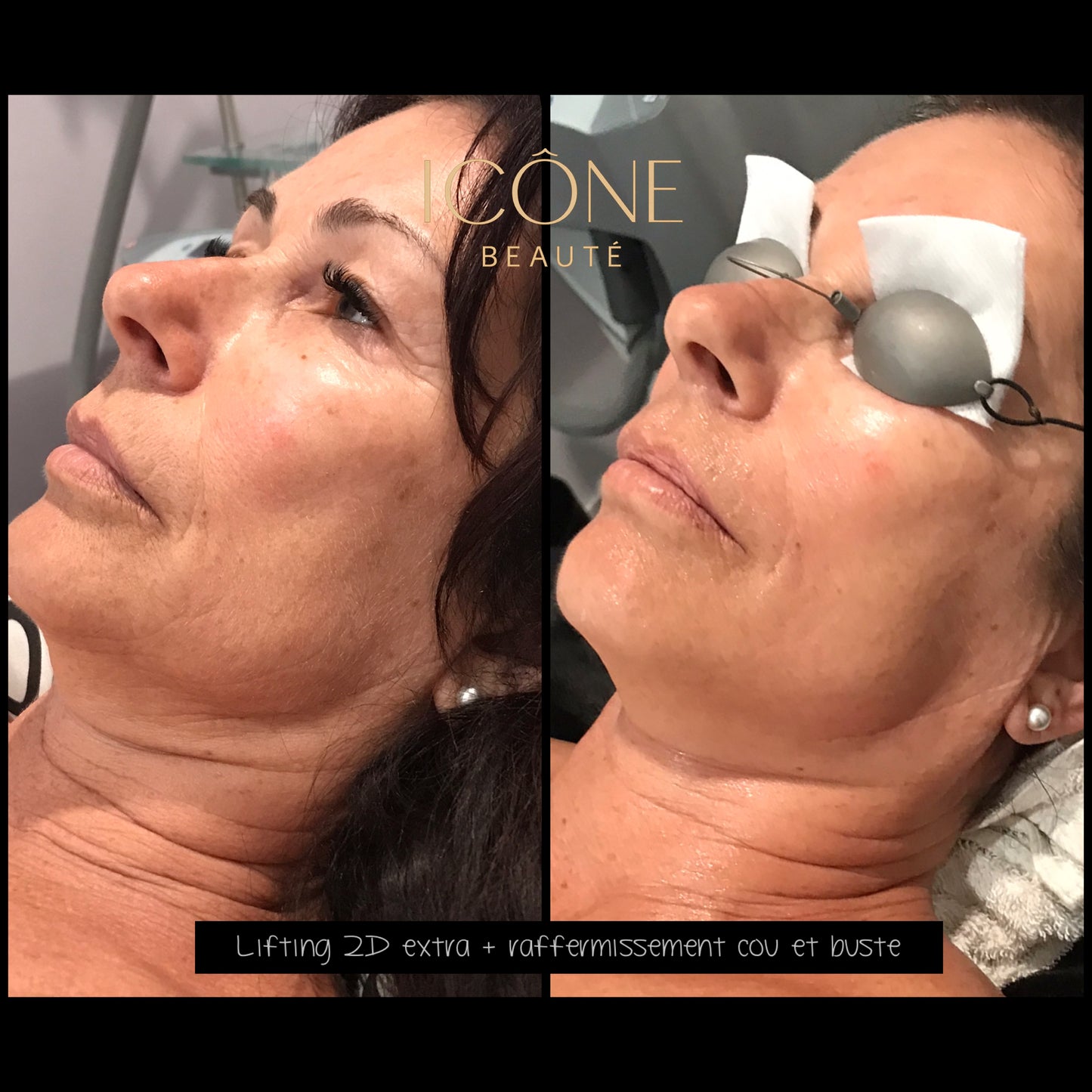 TightSculpting Fotona BASE à Québec | Raffermissement du bas du visage | Icône Beauté