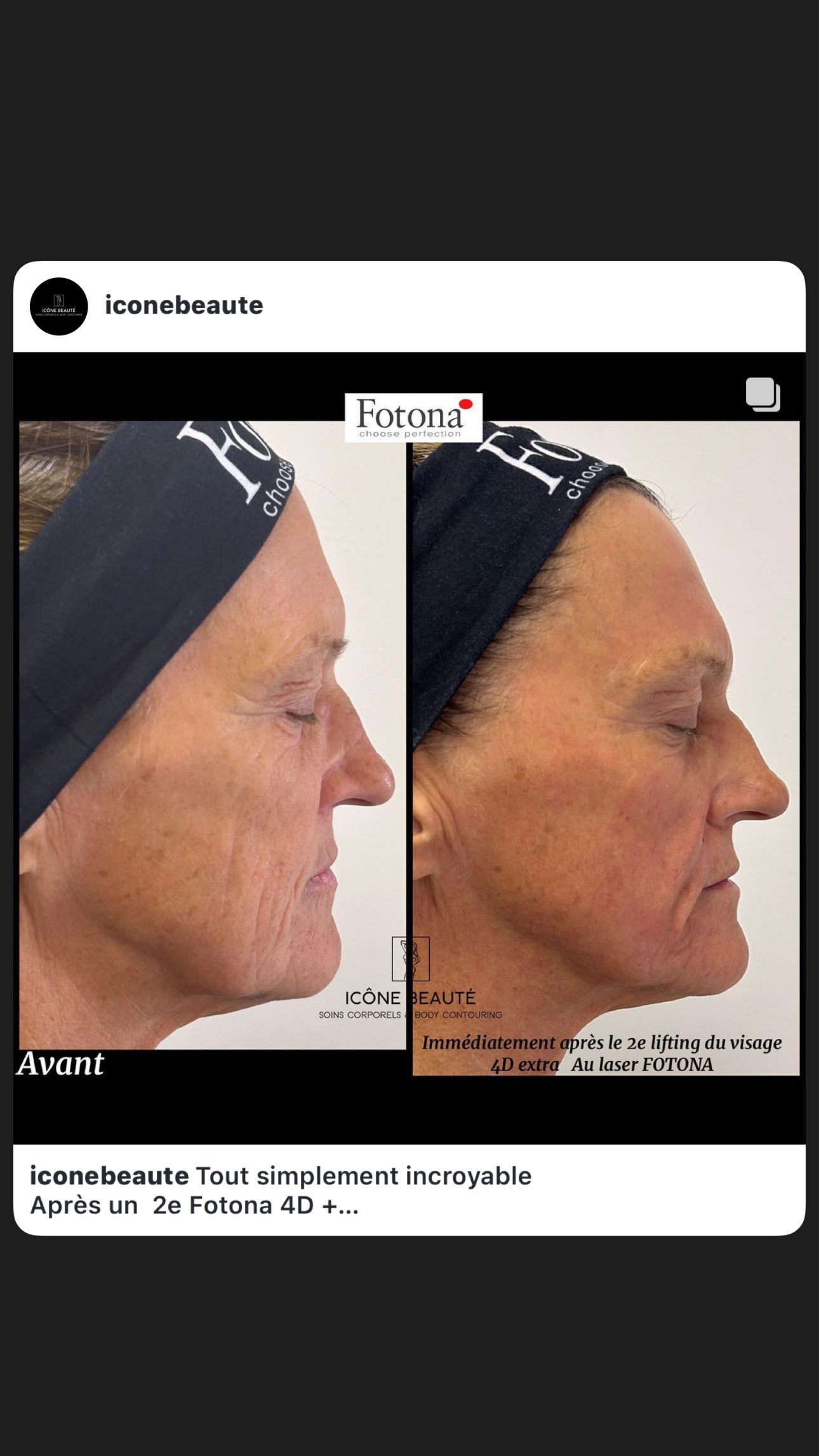 Soin signature Fotona 4D à Québec | SmoothEye + lifting visage complet | Icône Beauté