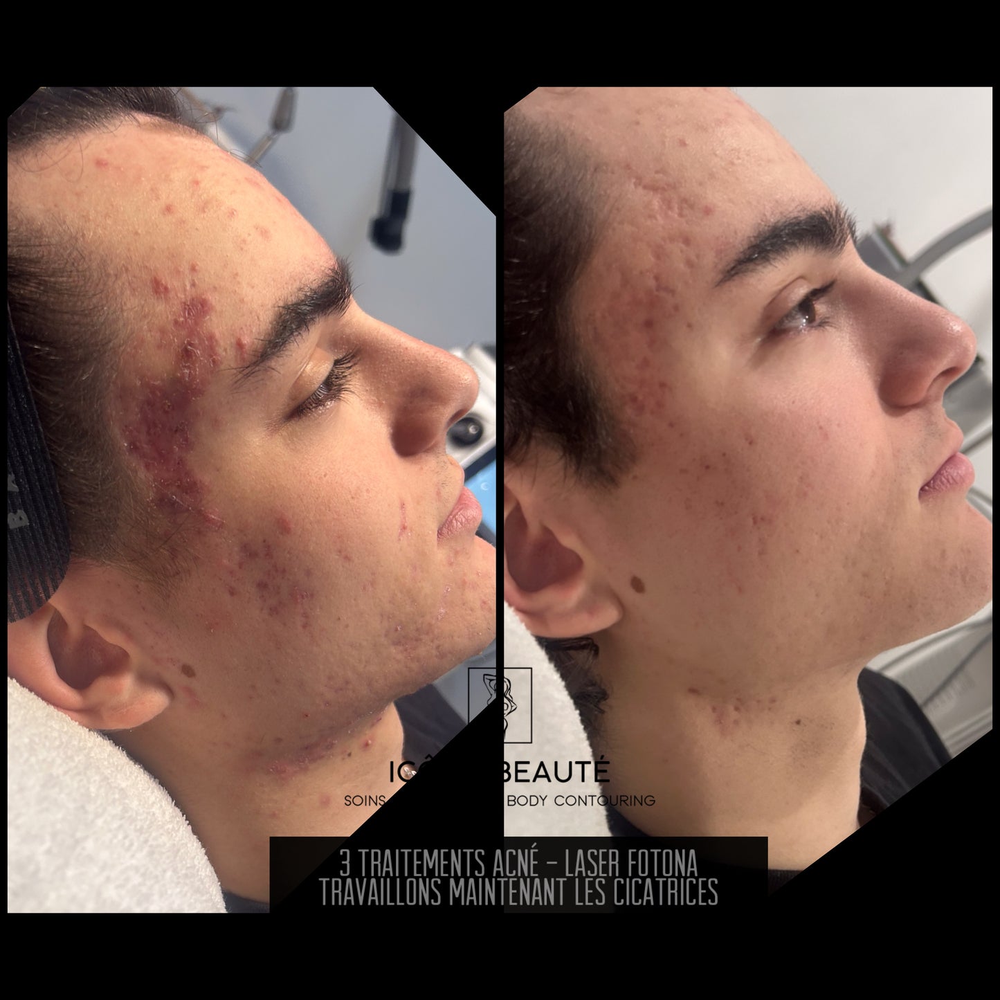 Traitement de l’acné au laser à Québec | Fotona SP Dynamis Pro | Icône Beauté