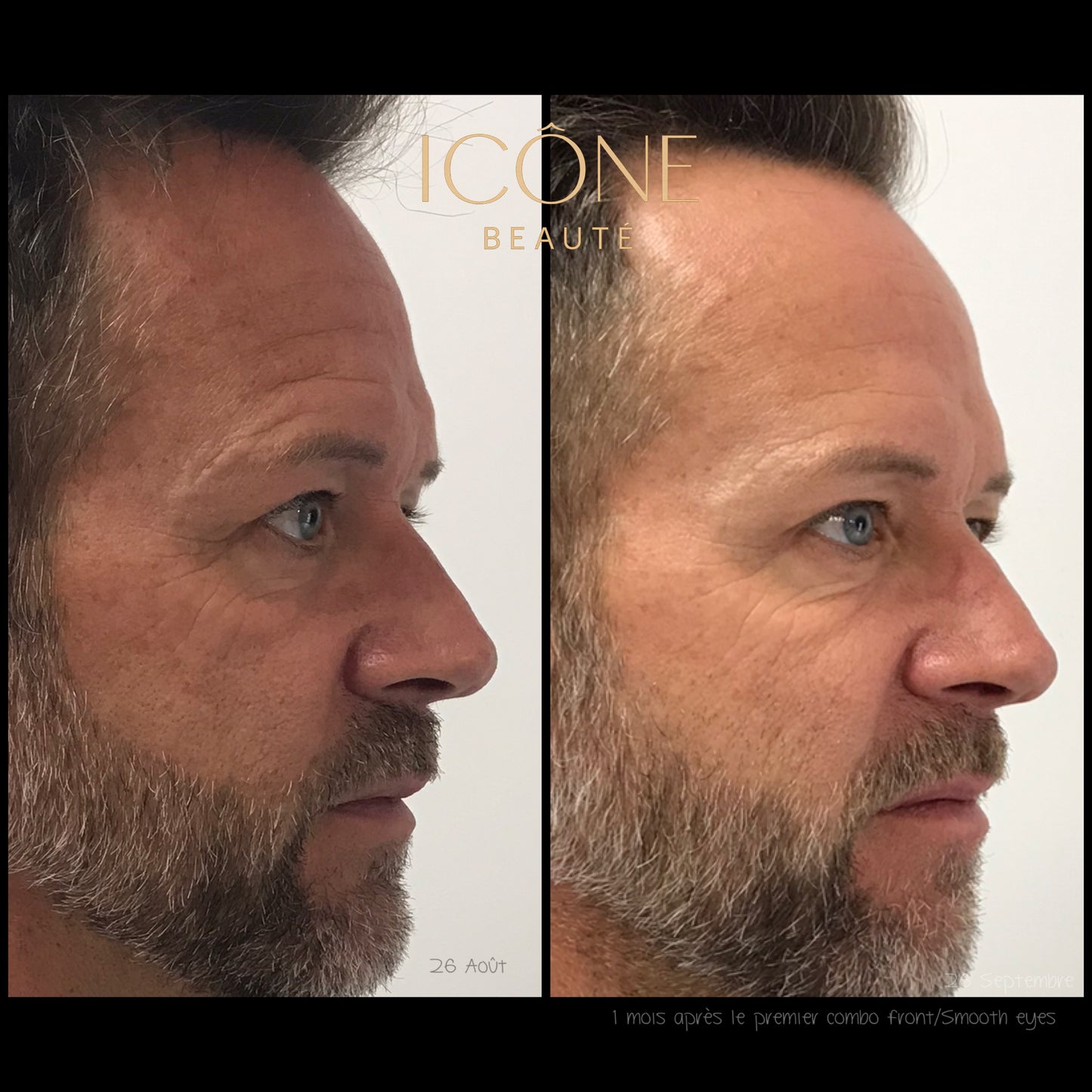 Combo : SmoothEyes® Fotona à Québec | Contour des yeux et front sans injection | Icône Beauté