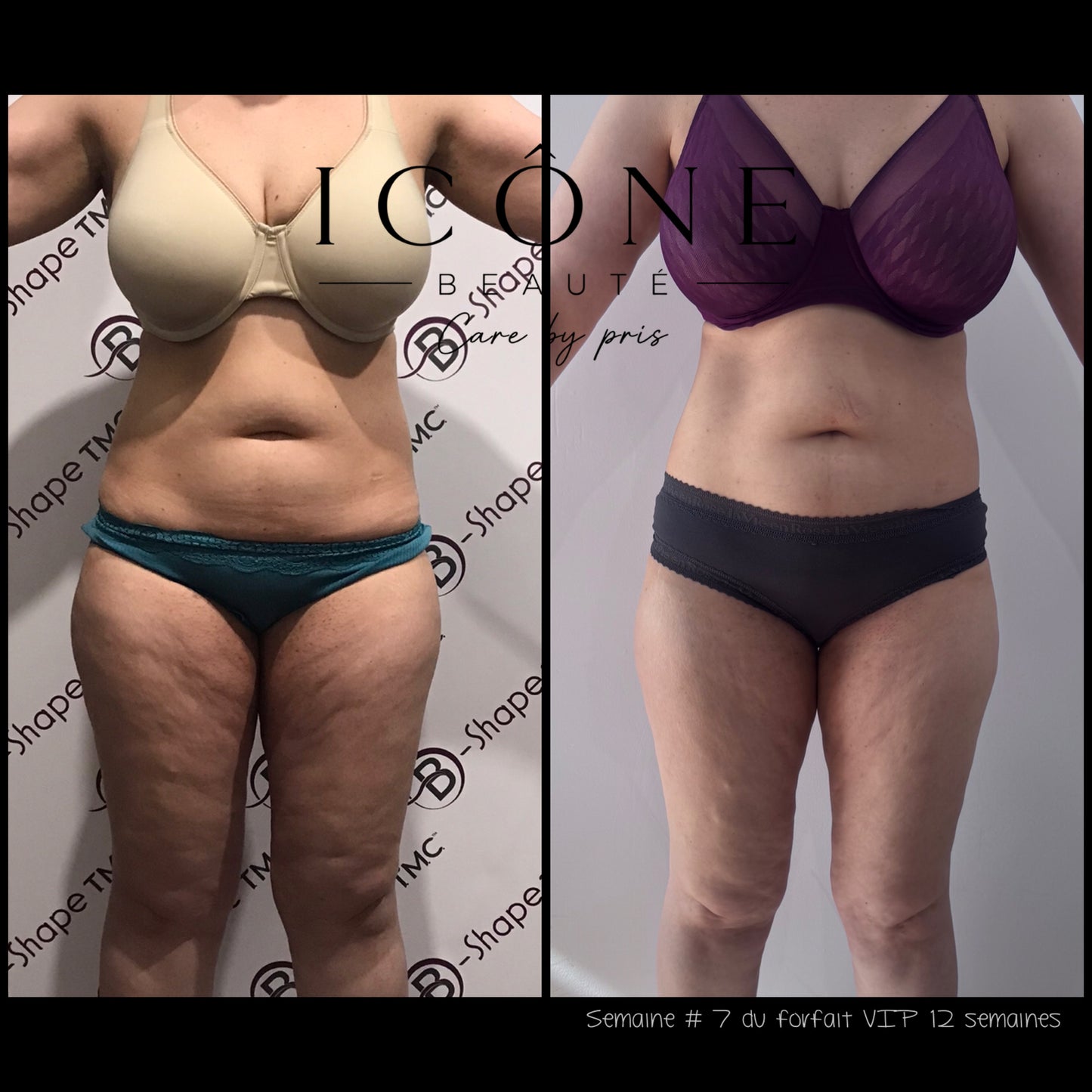Forfait VIP 3 Mois Sculpt, Drain & Lift Illimité | Icône Beauté Québec