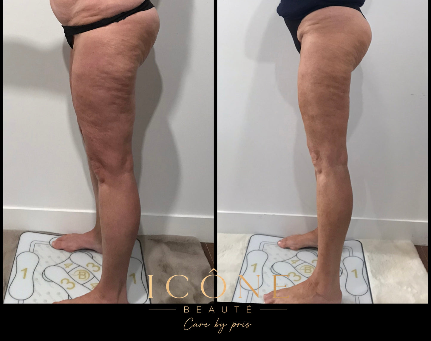 🍑 Lifting Colombien – Remodelage Fessier Sculptant