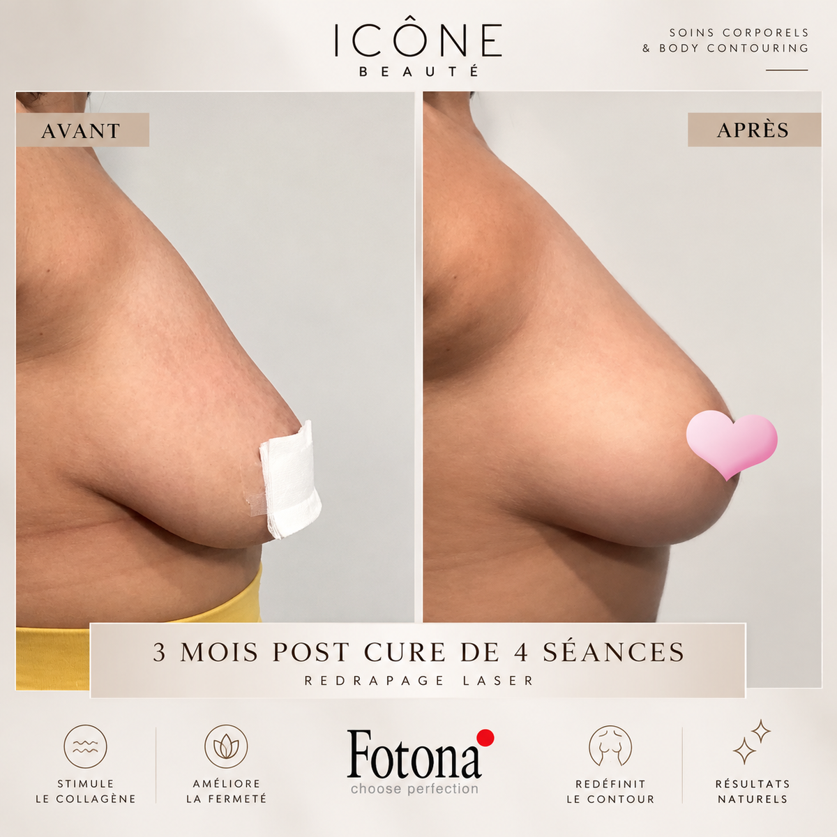 Raffermissement naturel du contour de la poitrine – Fotona