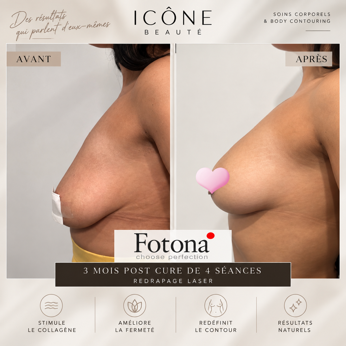 Raffermissement naturel du contour de la poitrine – Fotona