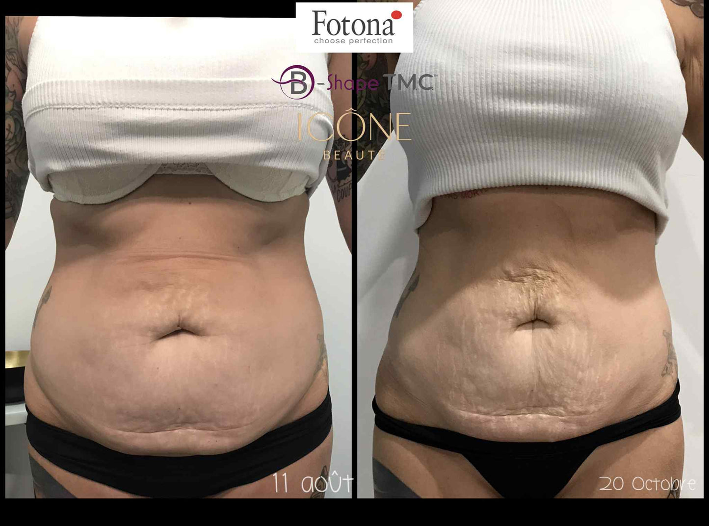 🔥 Hot & Tight Sculpting – Remodelage par Laser Fotona - CORPS