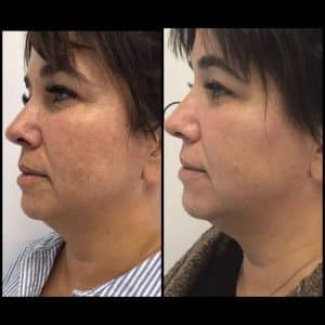 2D extra taches pigmentaires