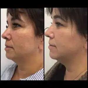 2D extra taches pigmentaires