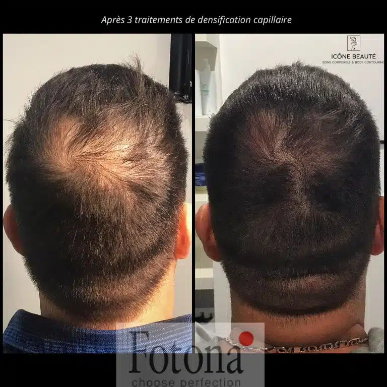 Densification Capillaire 1/2 tête