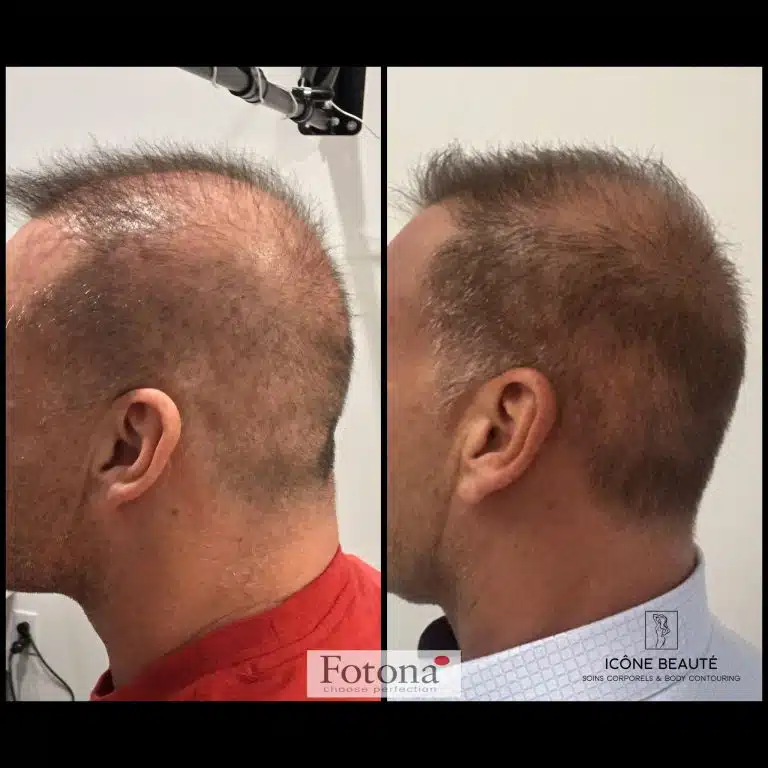 Densification Capillaire Tête Complète