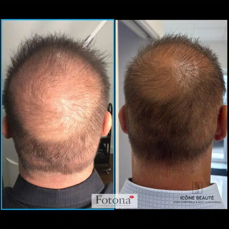 Densification Capillaire tête complète