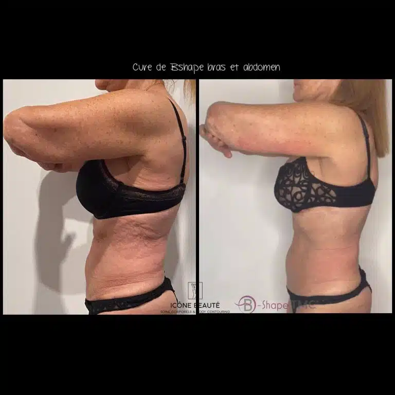 Cure 5x Bras & Abdomen 60 min