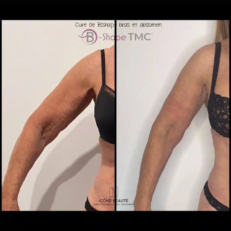 Cure 5x Bras & Abdomen 60 min