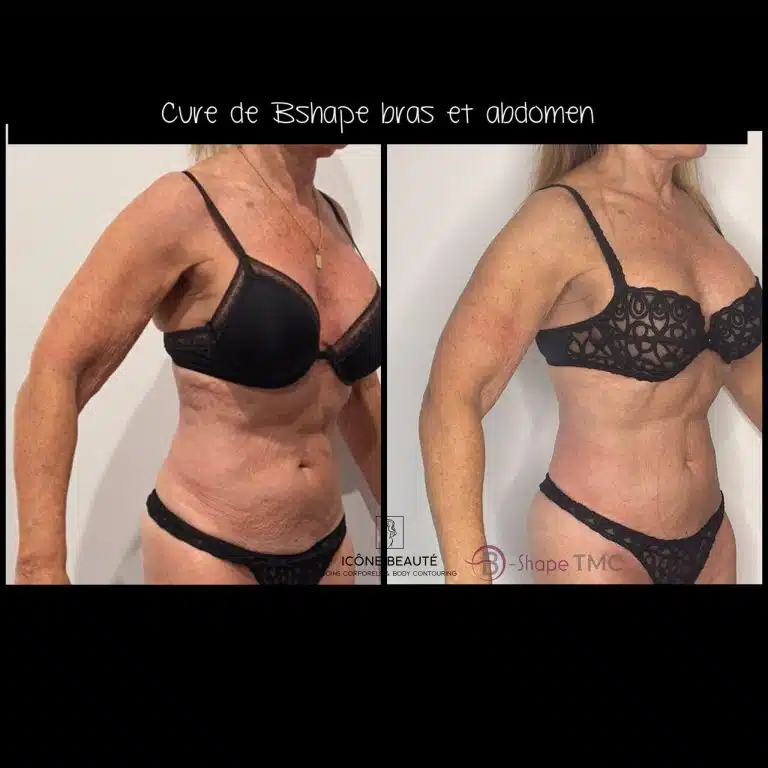 Bshape Cure Bras & abdomen