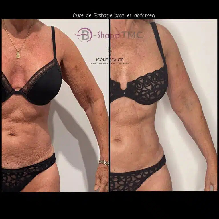 Cure 5x Bras & Abdomen 60 min