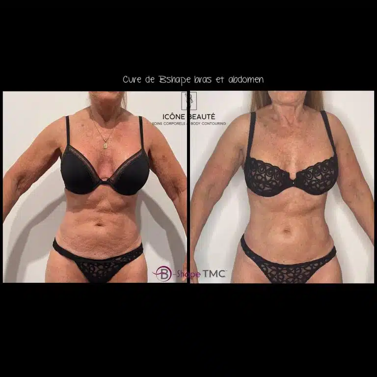 Cure 5x Bras & Abdomen 60 min